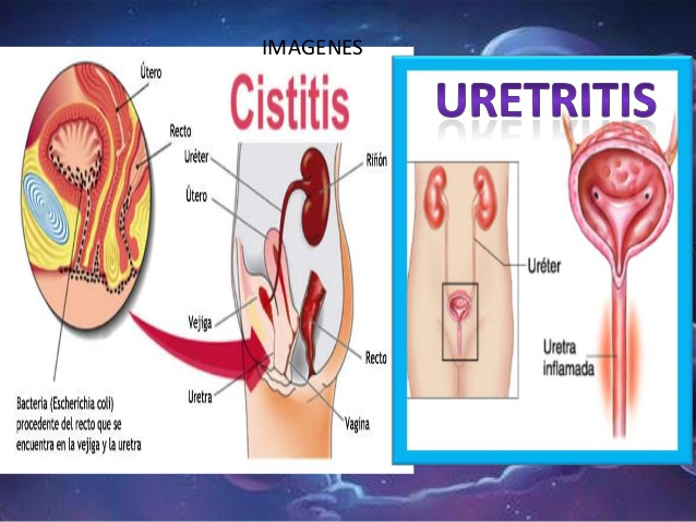 enfermedades del sistema urinario